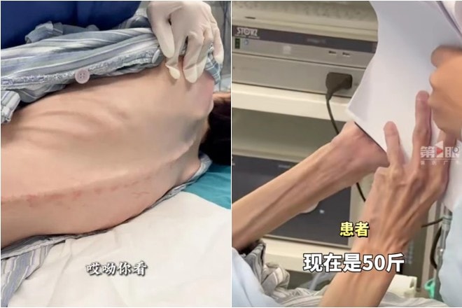 Hình ảnh cơ thể gầy trơ xương của người phụ nữ