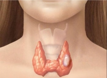 5 loại ung thư dễ chữa nhất nếu phát hiện sớm: Bạn đã biết chưa?