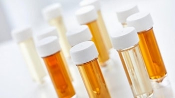 3 dấu hiệu bất thường ở nước tiểu cần cảnh giác