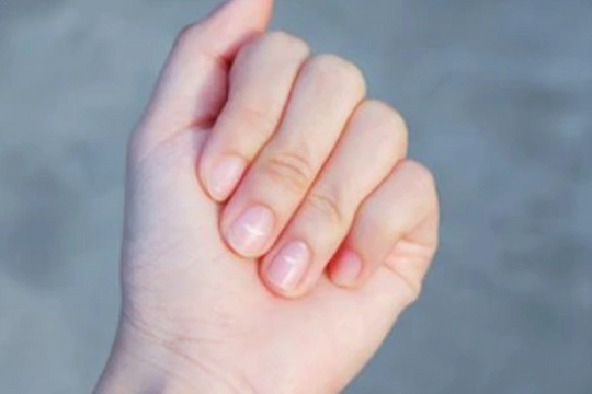 Nhìn móng tay bắt bệnh: Những dấu hiệu cảnh báo sức khỏe không nên bỏ qua